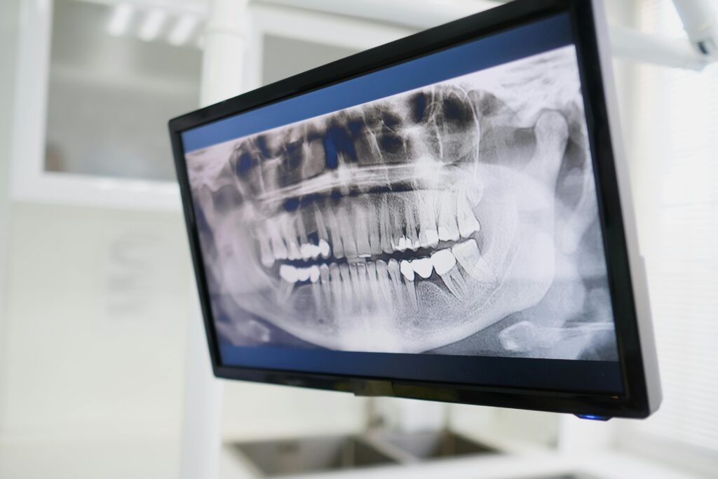 Close-up of a dental X-ray displayed on a monitor in a dental clinic setting, emphasizing dental care technology.