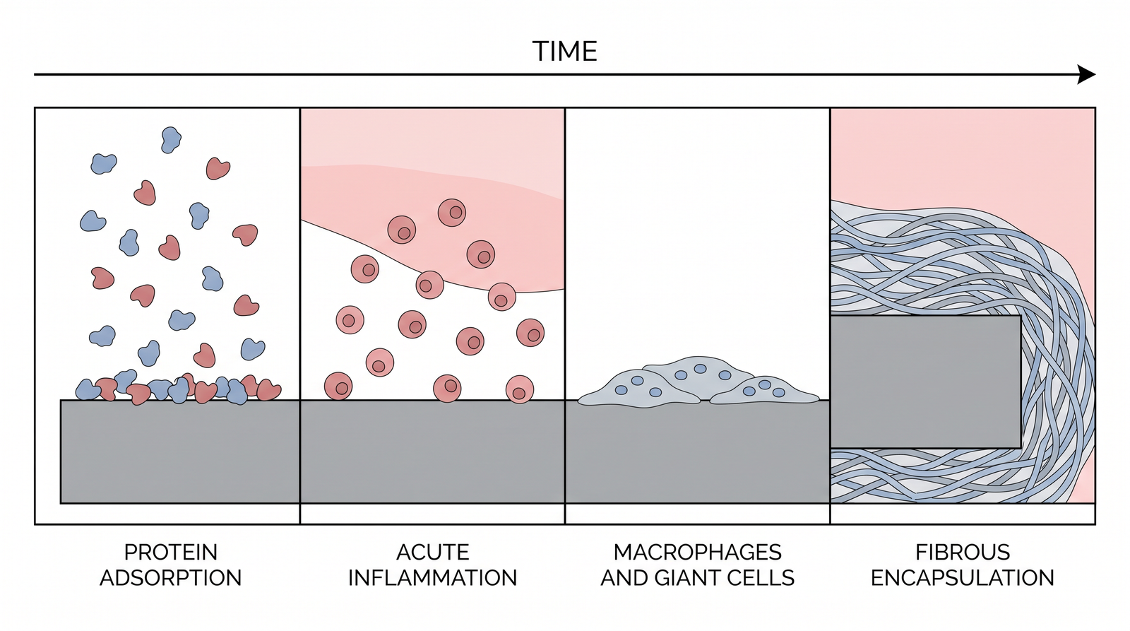 Four-stage diagram of the host response to an implanted biomaterial: protein adsorption within seconds, acute inflammation over hours to days, macrophages and foreign body giant cells adhering to the surface over days to weeks, and fibrous encapsulation from weeks onward