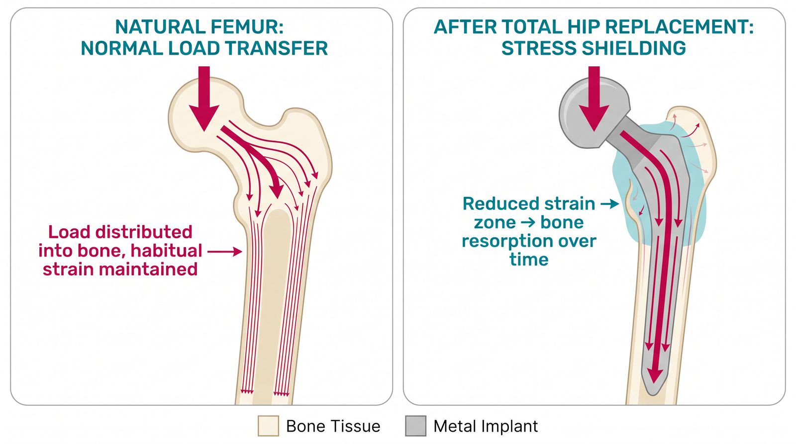 Side-by-side comparison of a natural femur with normal load transfer into bone versus a femur after total hip replacement showing stress shielding, where the stiffer metal stem carries most of the load and the reduced-strain proximal bone region undergoes resorption over time